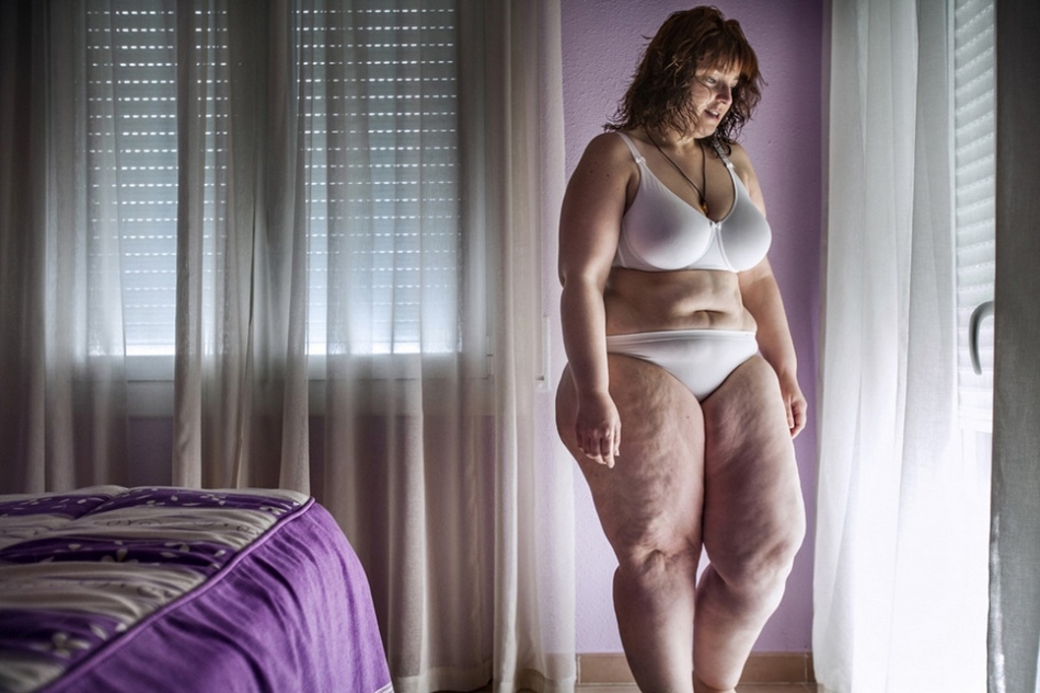 西班牙女子手术减肥心路历程”