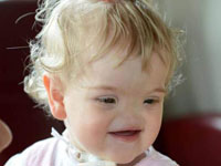 女婴天生无鼻无法闻味道 从未停止微笑”