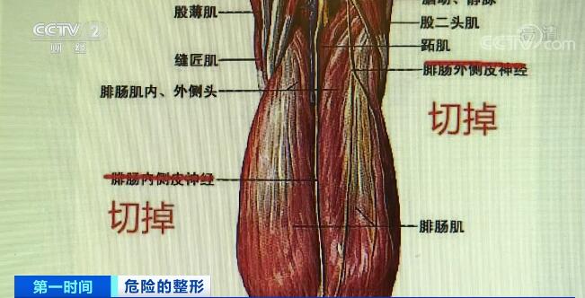 从而达到瘦小腿"后群肌"的目的