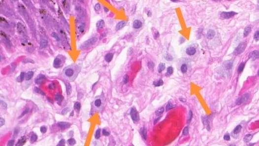 新疗法让肥大细胞变身“杀瘤先锋”