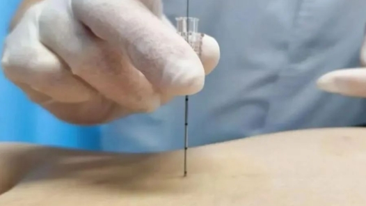 埋线、针灸、食疗……这届青年迷上中医“花式减重”